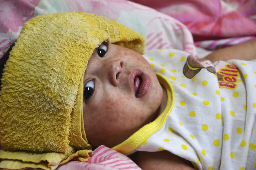 Norwell Pediatrics - Infant with rash